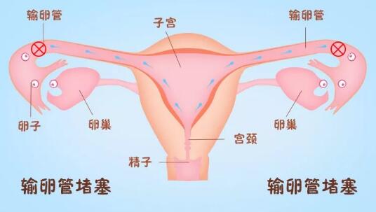 侧输卵管粘结堵塞