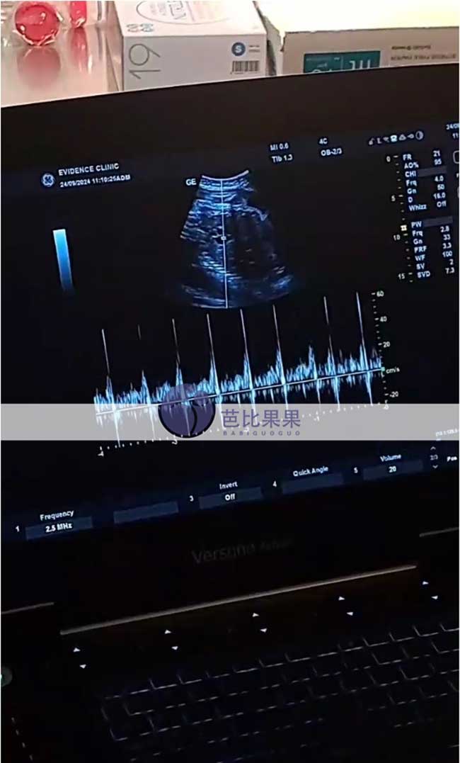 试管妈妈孕36周B超