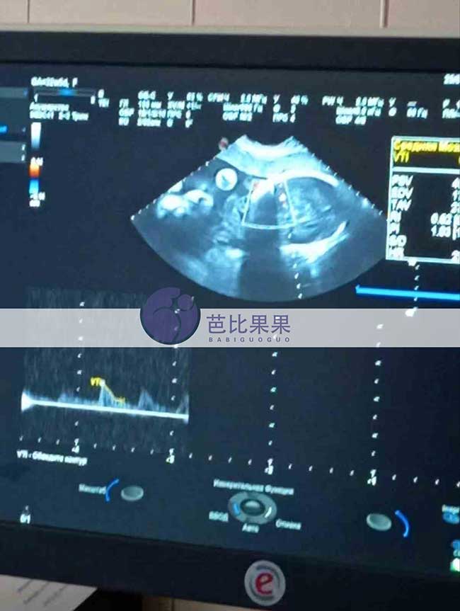 乌克兰试管妈妈做B超