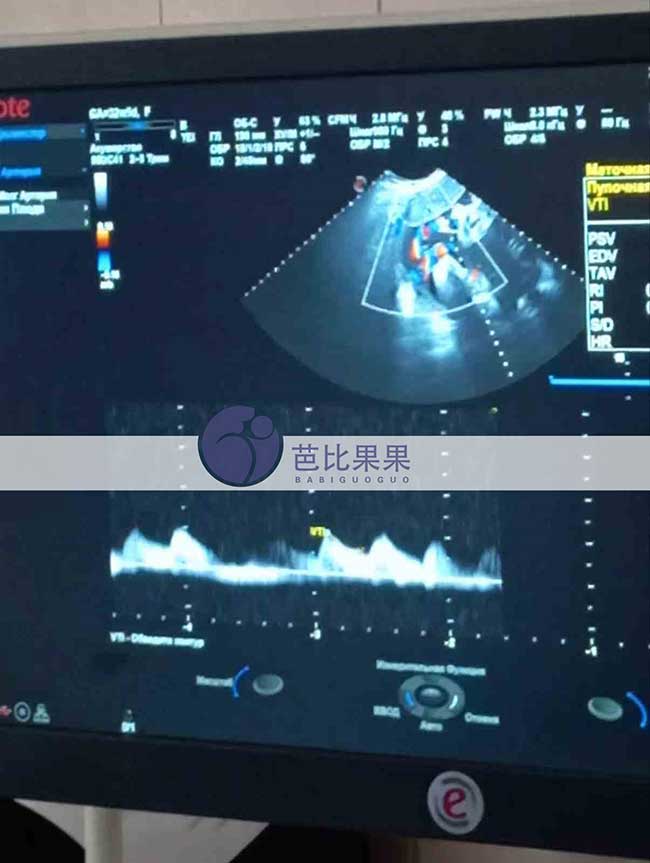 乌克兰试管妈妈做B超