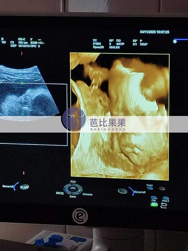 试管妈妈做四维彩超