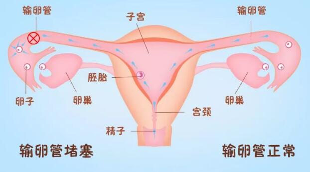 右侧输卵管通畅