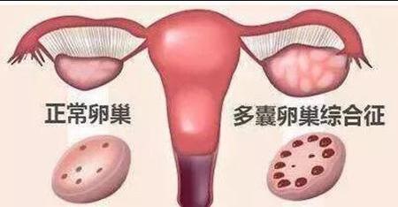 多囊卵巢综合症