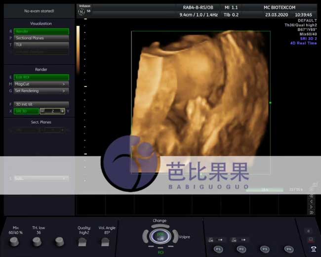 乌克兰百奥医院试管Z先生的宝宝做四维彩超