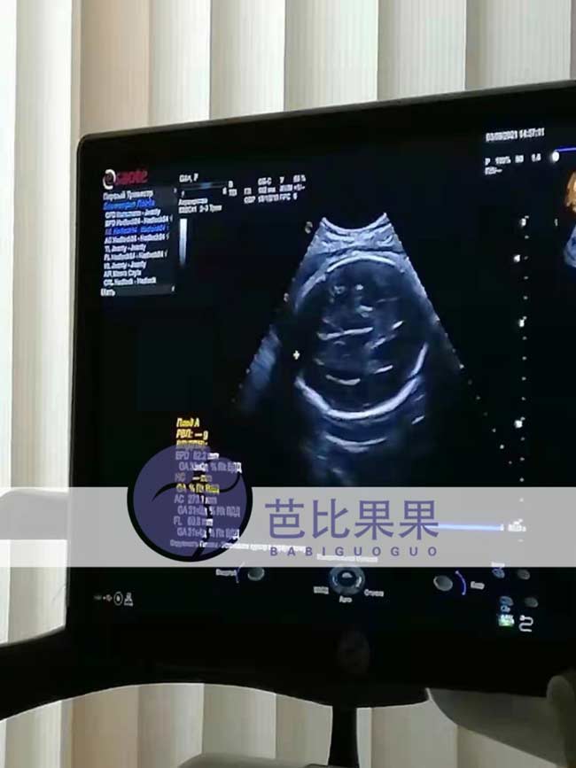 乌克兰试管孕妈做产检