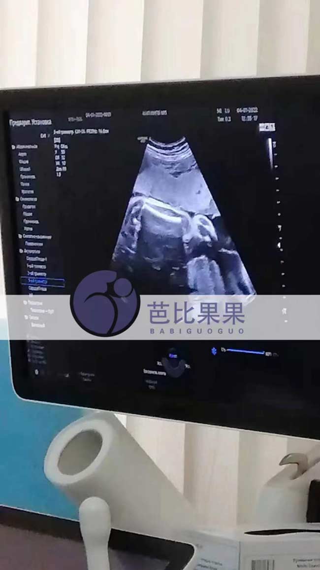 乌克兰怀孕30周的孕母做B超