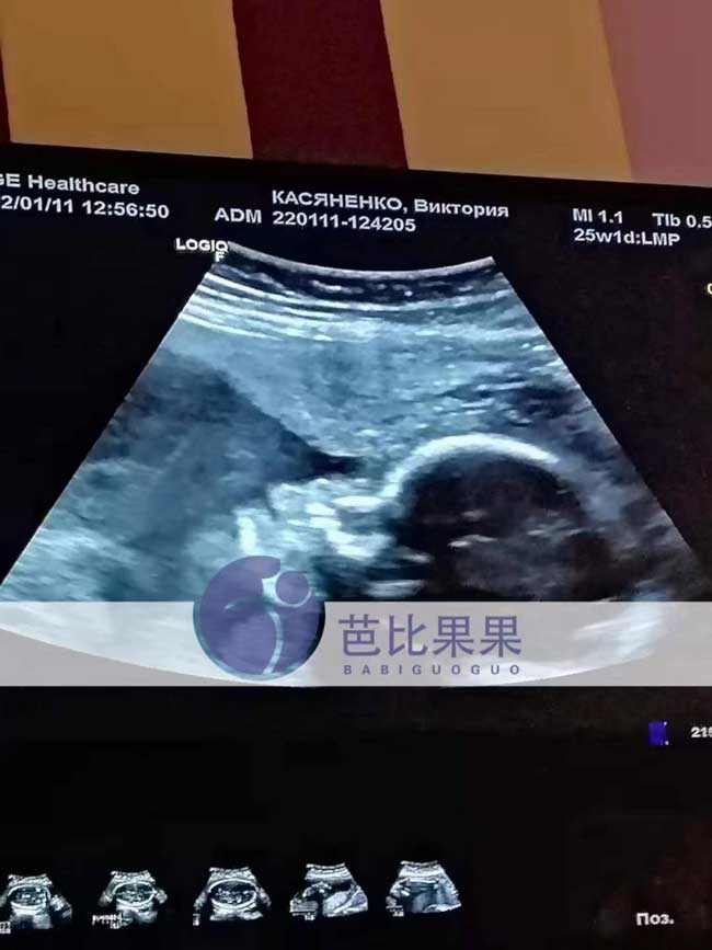 乌克兰孕妈做四维彩超