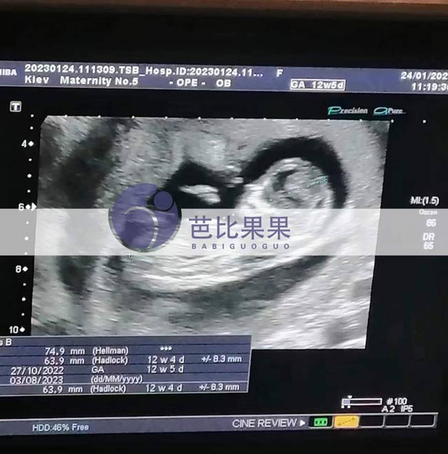 乌克兰试管妈妈孕12周产检