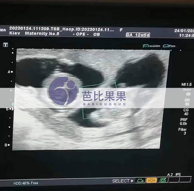 乌克兰试管妈妈孕12周产检