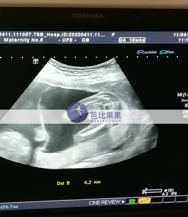 乌克兰试管妈妈孕18周B超