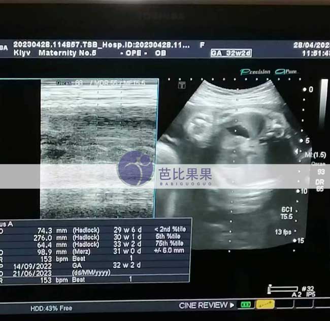 乌克兰试管妈妈孕32周B超