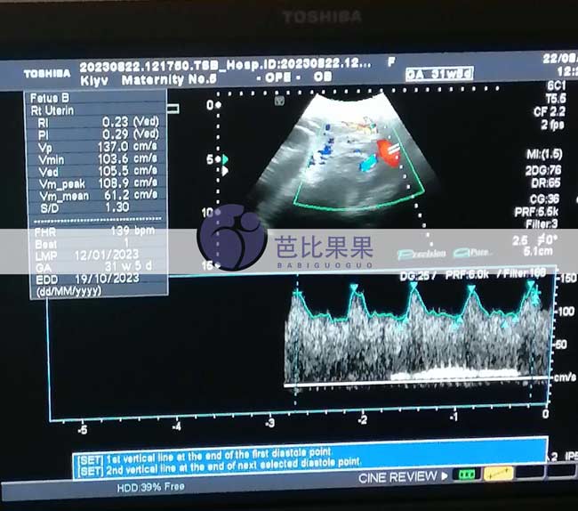 乌克兰试管妈妈孕31周B超