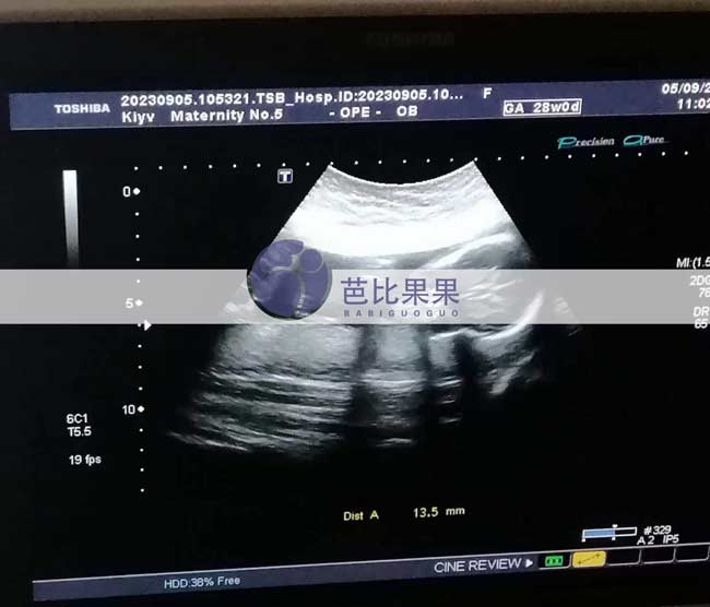 乌克兰试管妈妈孕18周B超