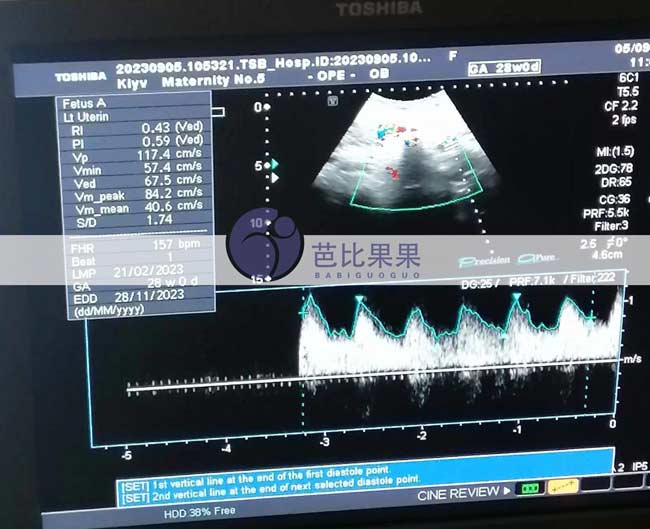 乌克兰试管妈妈孕18周B超