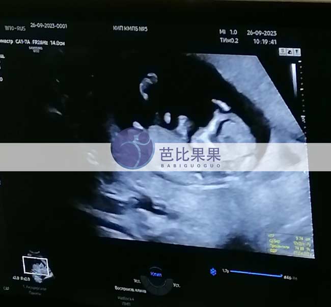 乌克兰试管妈妈孕12周产检