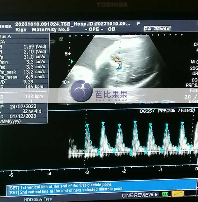 乌克兰试管妈妈32周B超