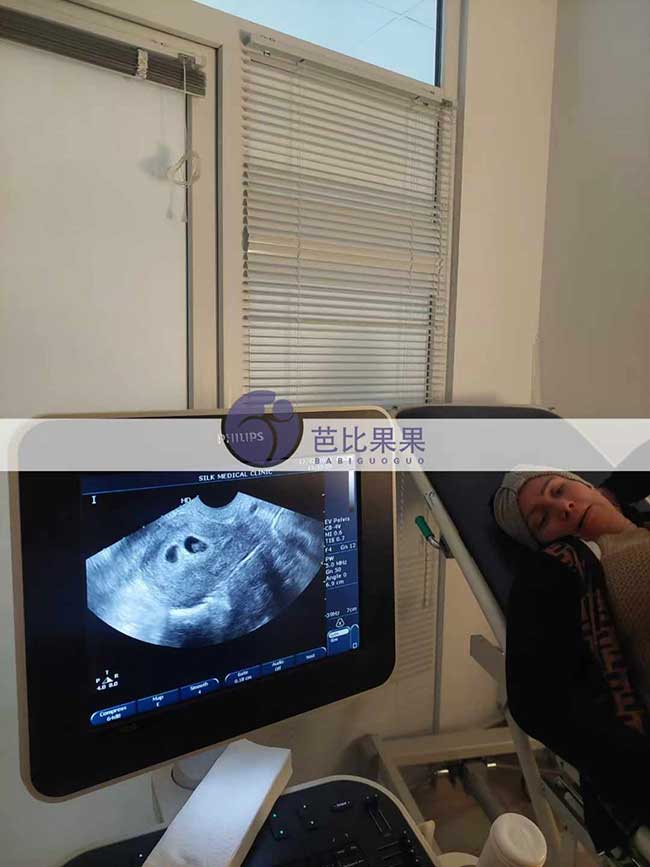试管妈妈着床双胞胎