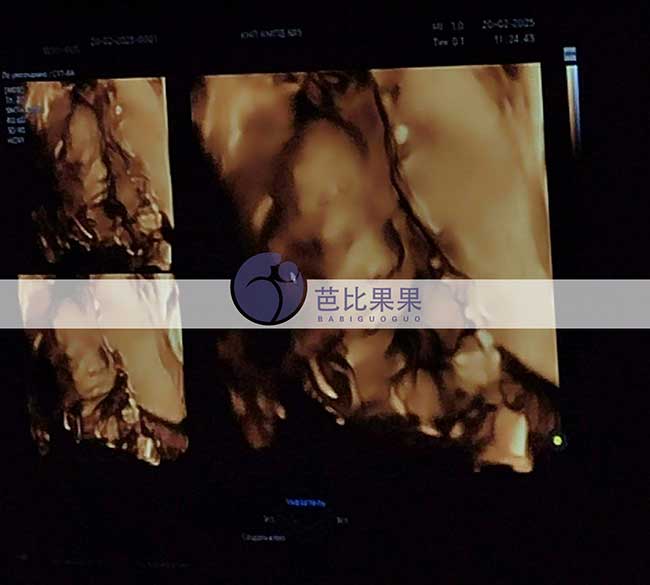 试管妈妈做四维彩超