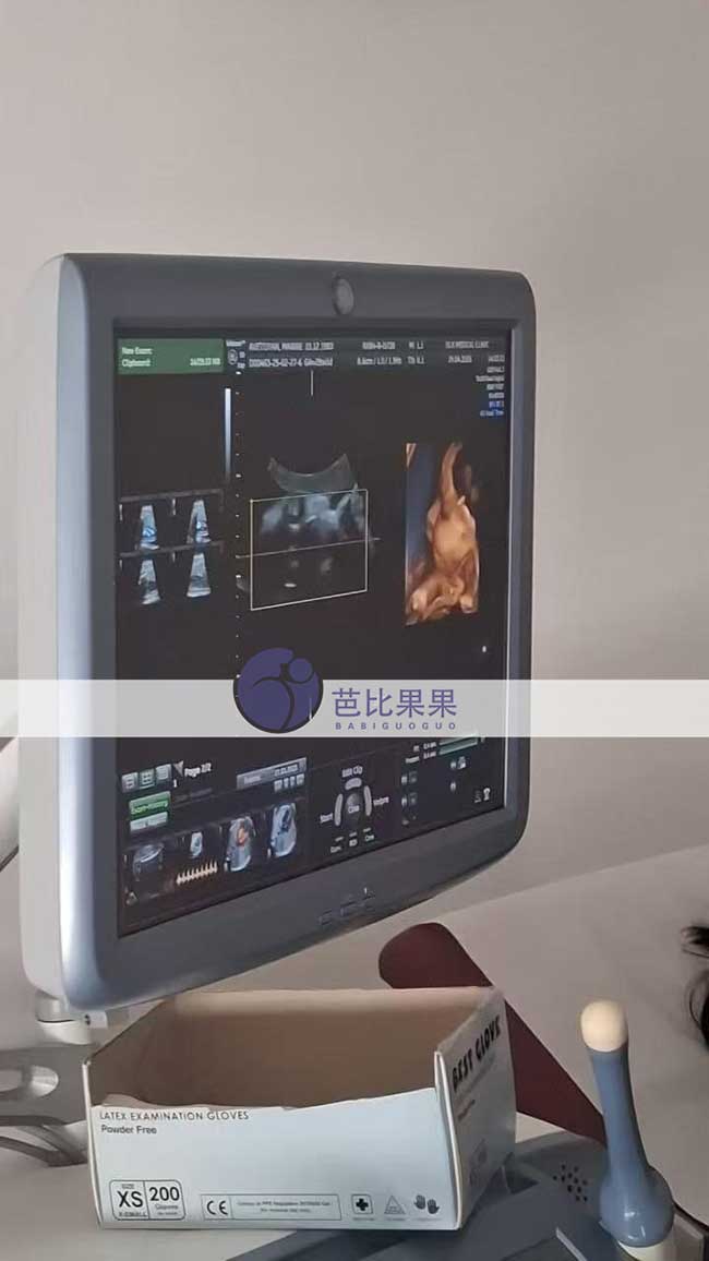 试管妈妈做四维彩超