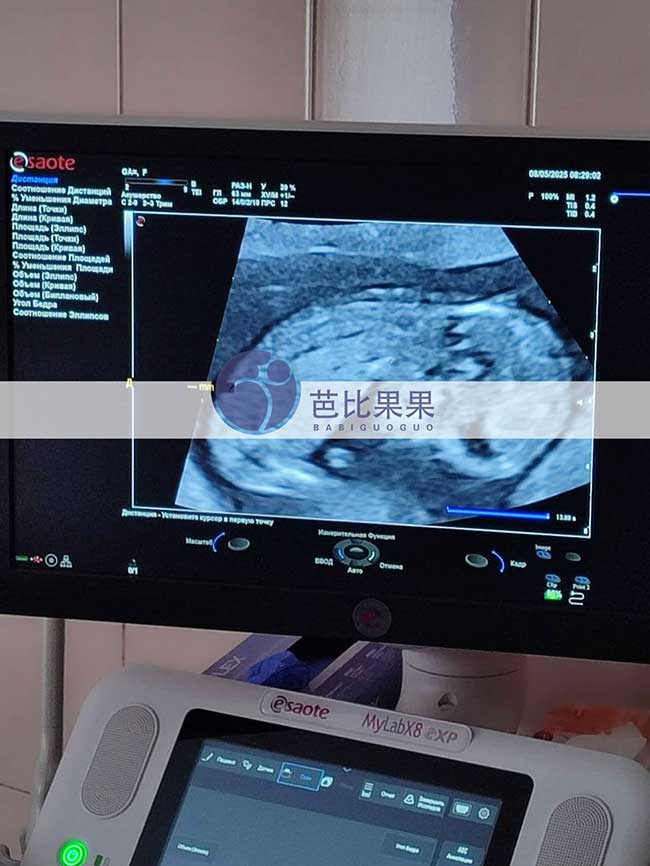 试管妈妈做B超