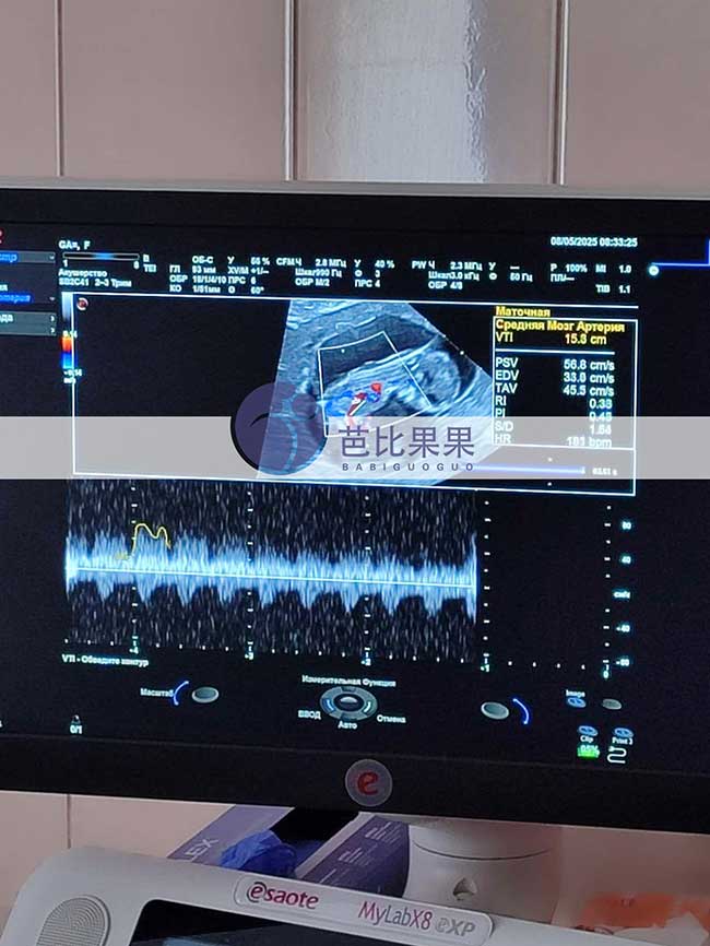 试管妈妈做B超