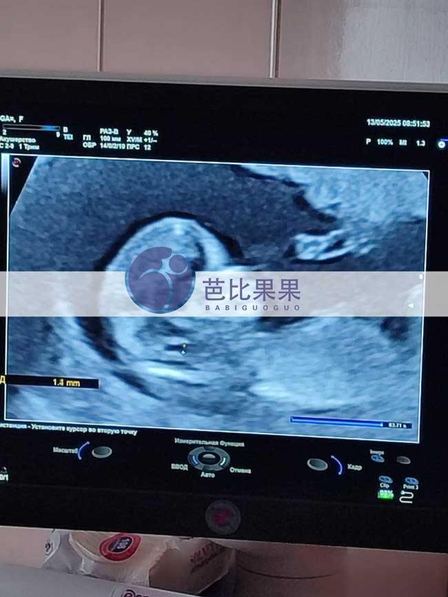 试管妈妈孕13周B超