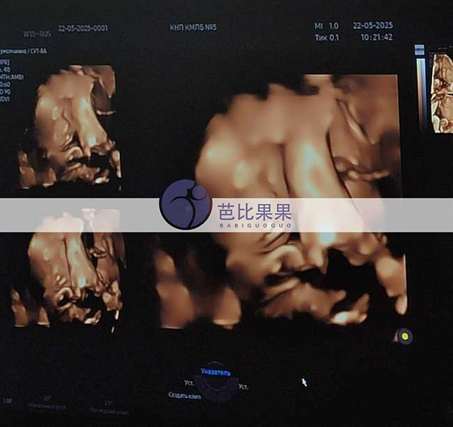 试管妈妈做四维彩超