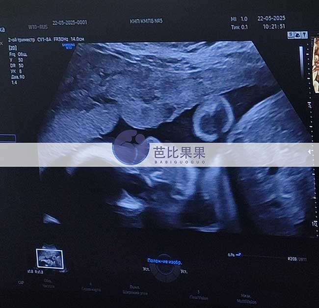 试管妈妈做四维彩超