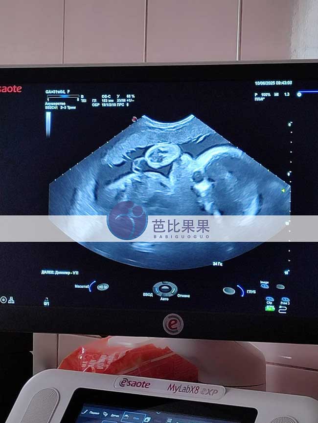试管妈妈做B超