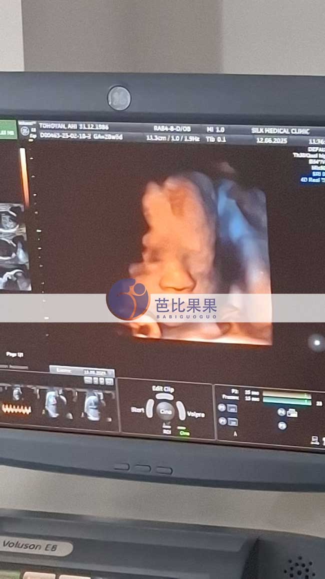 试管妈妈做四维彩超