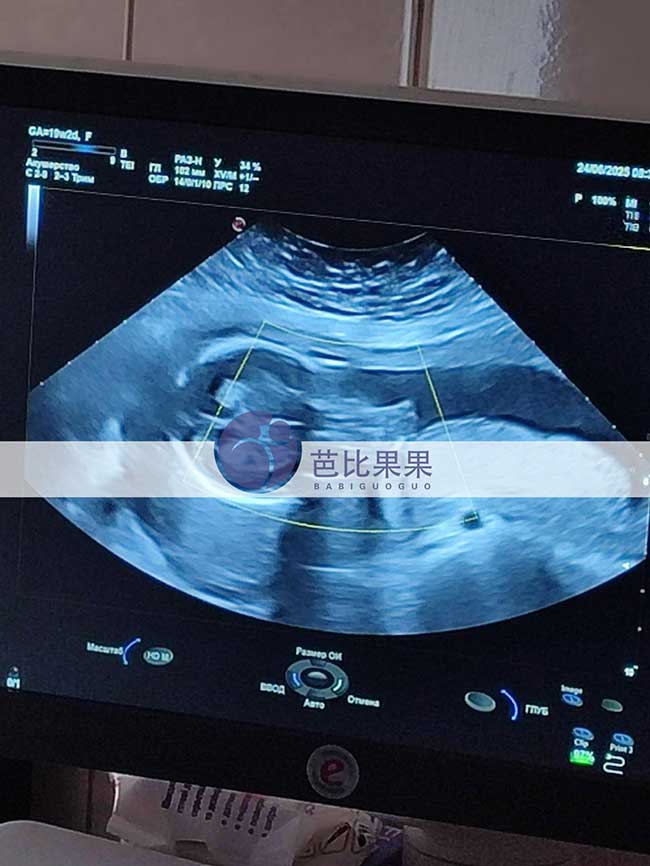 试管妈妈做B超