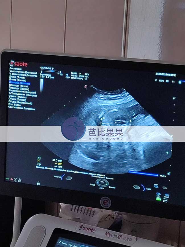 试管妈妈做B超