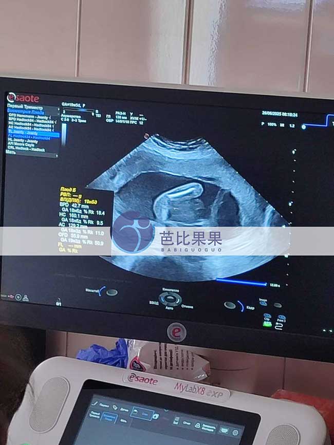 试管妈妈做B超
