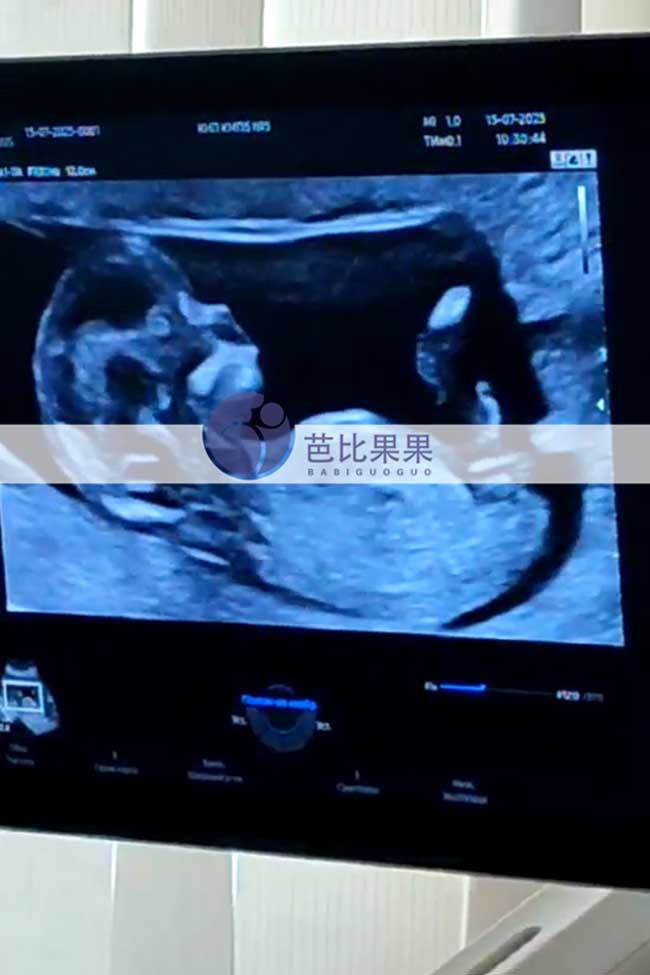 乌克兰试管妈妈做B超