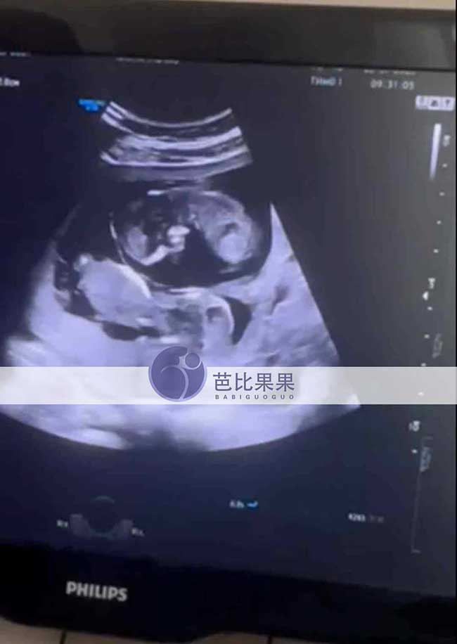 试管妈妈做B超