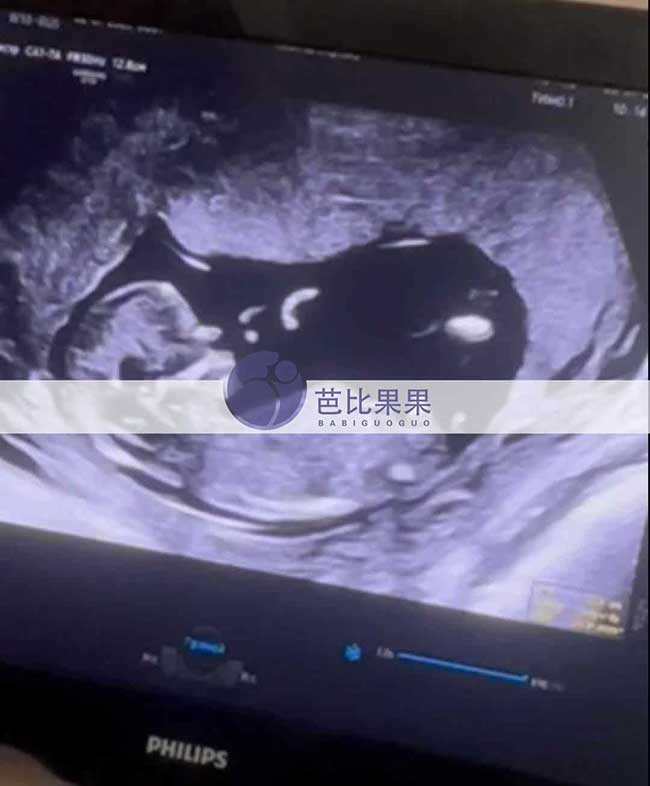 试管妈妈做B超