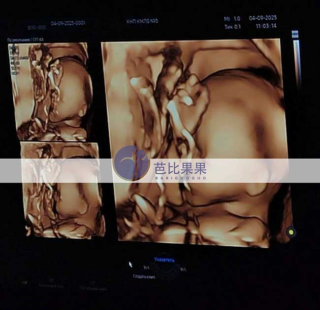试管妈妈做四维彩超