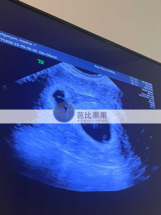 试管妈妈做B超