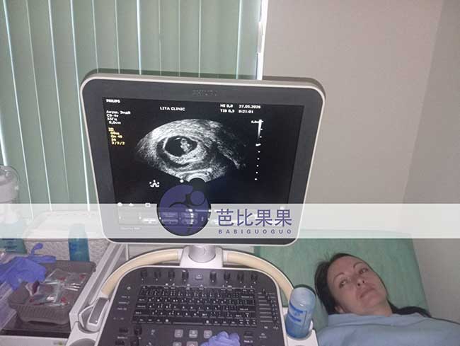 乌克兰试管二胎案例更新:梁先生家庭8周B超顺利通过