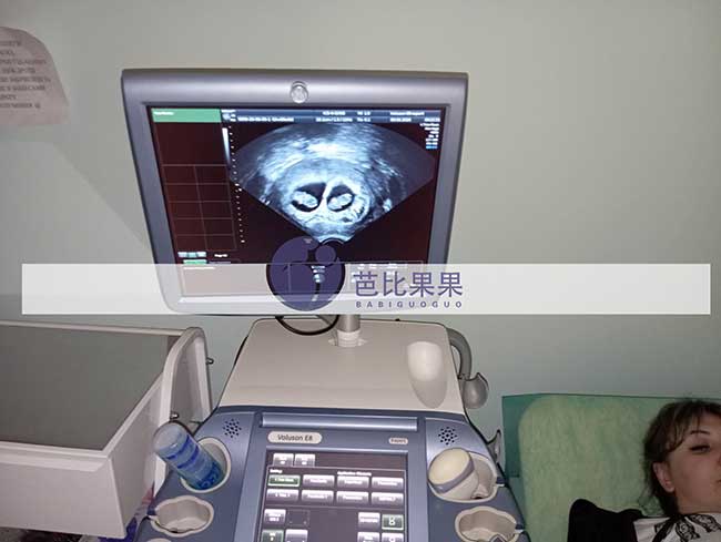 乌克兰试管二胎案例更新:张先生家庭双胎孕早期B超顺利通过