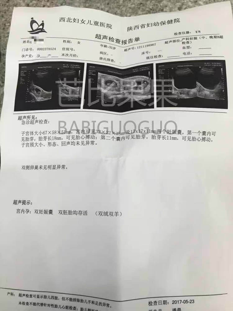 iBaby生殖中心 B超两个宝宝都着床