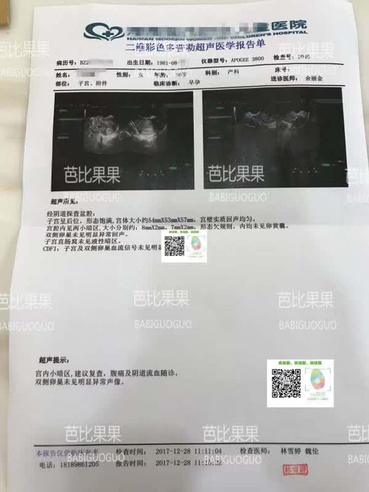 深圳L女士首次做B超观察 宫内着床双胞胎