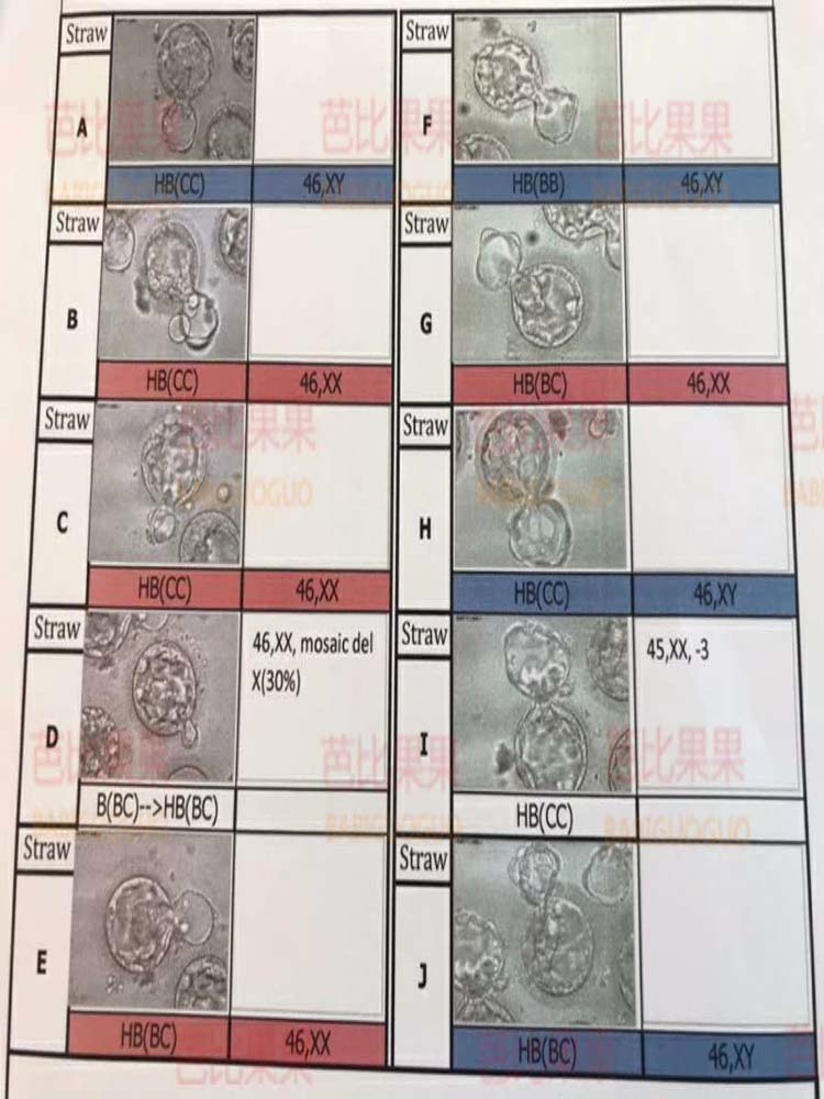 试管婴儿胚胎筛查报告